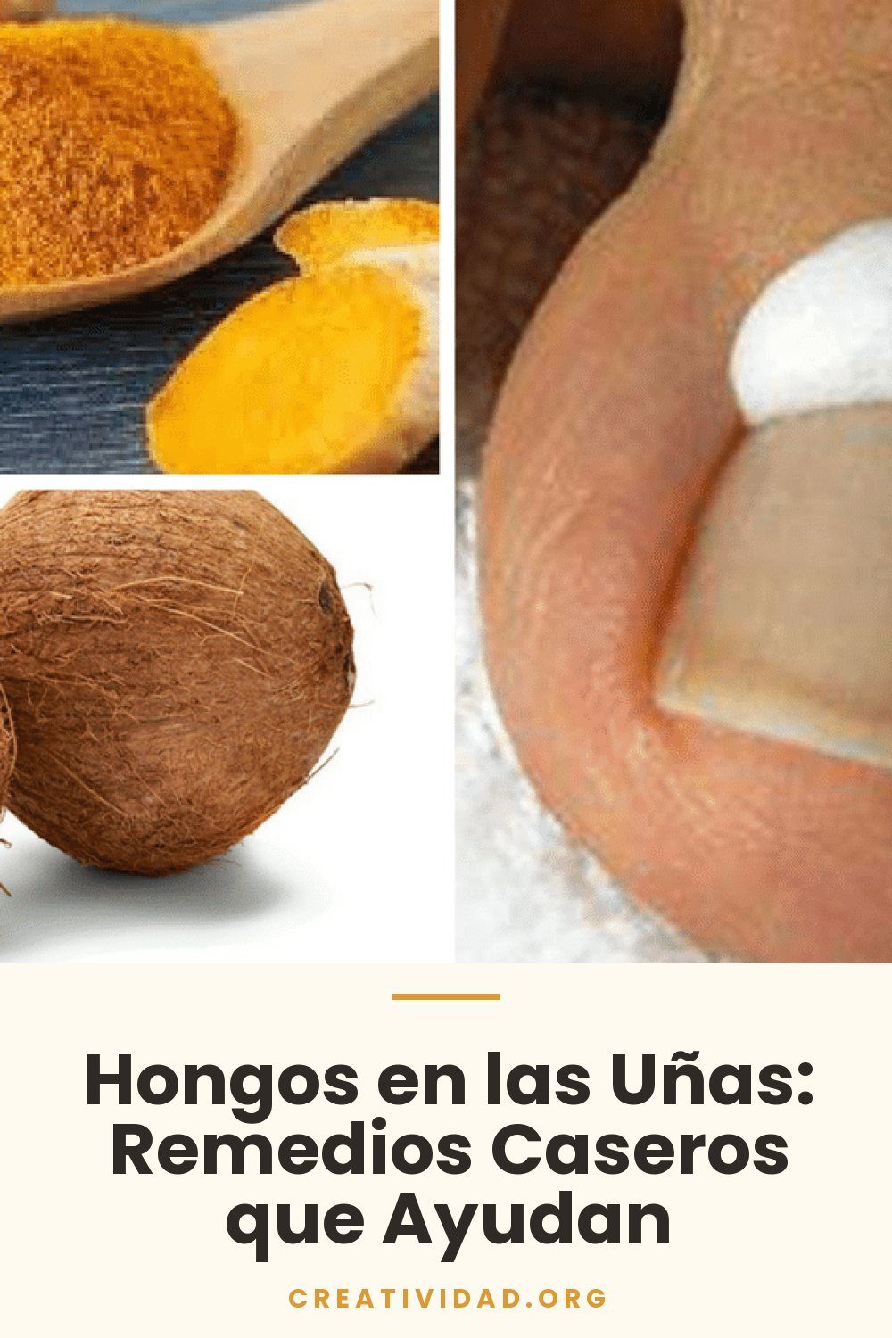 Hongos en las Uñas: Remedios Caseros que Ayudan